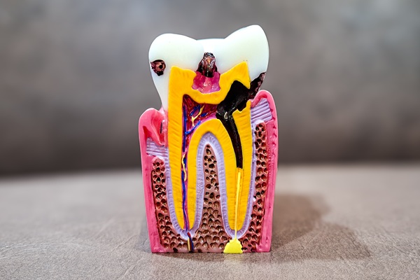 Teeth Replacement    : Dental Implants