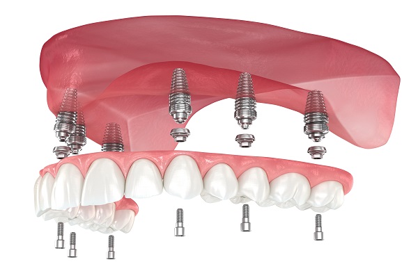 Implant Supported Dentures Chesapeake, VA