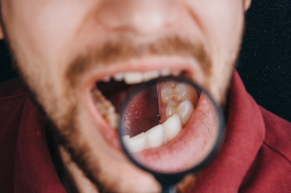 Risk Factors For Oral Cancer